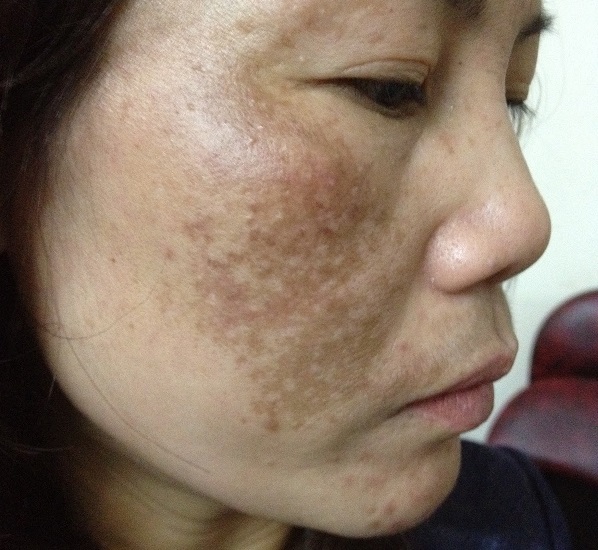 Nám mảng là một dạng rối loạn sắc tố da, các vùng da sậm màu có màu nâu, vàng hoặc xám.