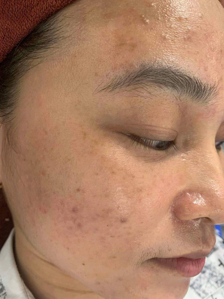 Có rất nhiều nguyên nhân dẫn đến tình trạng đốm nâu trên da