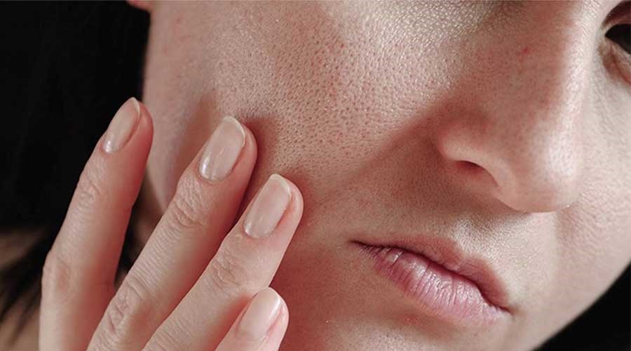 Da thiếu độ ẩm khiến nám dễ xuất hiện